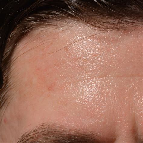 Sweating Face Causes