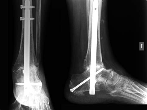 Arthroscopic Ankle and Subtalar Arthrodesis – Indications and Surgical ...