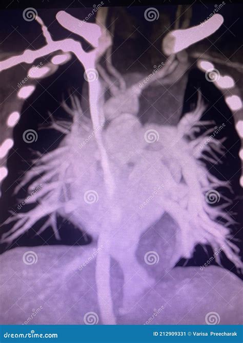 CT Scan Angiogram Show Dextrocardia the Congenital Heart Disease Stock