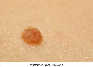 Mole On Human Skin Stock Photo 88269256 | Shutterstock