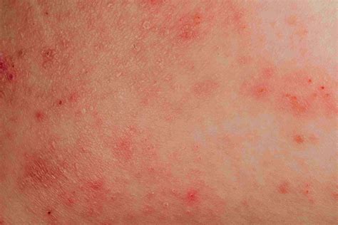 Skin rashes that itch all over body - matchJuli