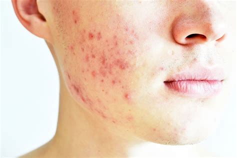 Inflamation related to Acne | Randwick, Sydney | ben&biao