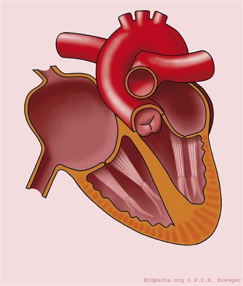 fileright atrial enlargementjpg ecgpedia