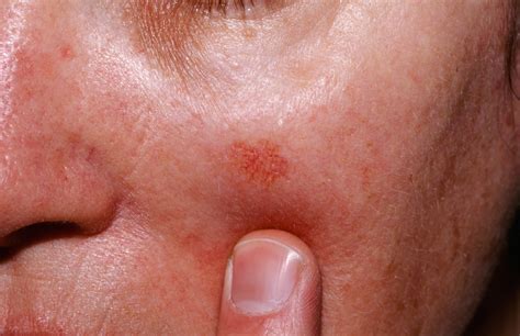 Actinic Keratosis - Causes, Symptoms & Actinic Keratosis Treatment