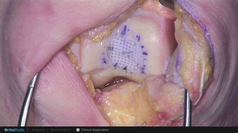 Osteochondral Lesions: Cartiform® Viable Osteochondral Allograft Procedure for Trochlear Defects ...