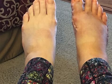 How Long After Surgery Can You Shower With Stitches at Herman Bond blog