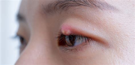 What is a Stye? Symptoms Causes Treatment Preventions - Symptom Clinic