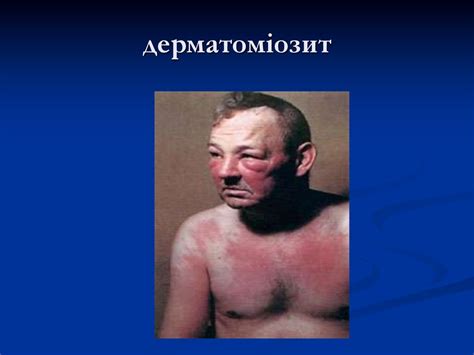Системна склеродермія (системний склероз) - презентация онлайн