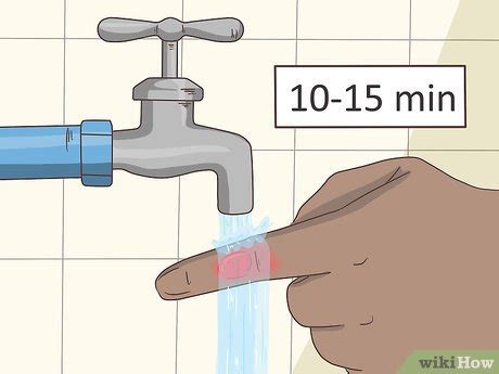 O'que Fazer Quando Queima O Dedo - Como Tratar uma Queimadura com Bolhas nos Dedos - wikiHow