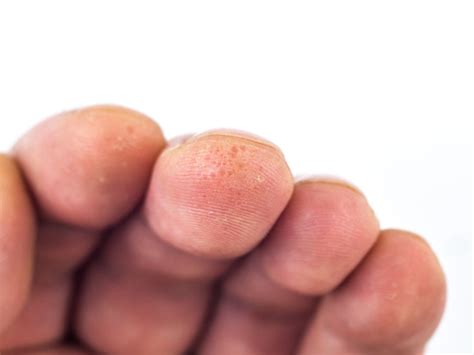 Dishidrozinė egzema - Dermatologo konsultacija internetu - iDerma.lt