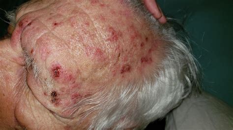 Sulfa (bactrim) rash? : DermatologyQuestions