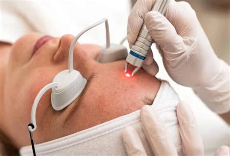 ktp laser renske ypma skin clinics