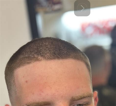 Before and after on minoxidil 5 months : r/tressless