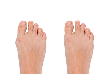 Premium Photo | Hallux valgus deformity of big toe caused by wearing ...