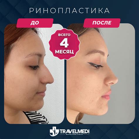 Ринопластика - TravelMEDI