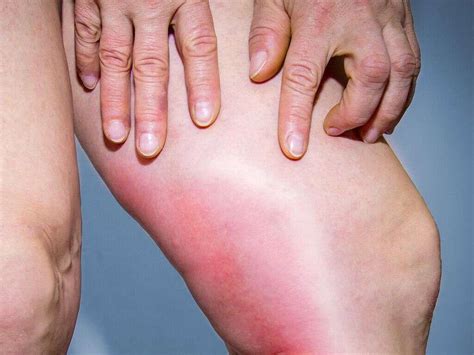 Blood Clots Symptoms In Legs at Nicholas Walker blog