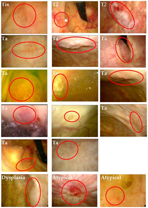 Cystoscopy Accuracy in Detecting Bladder Tumors: A Prospective Video