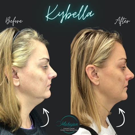 kybella    botox fillers botox dermal fillers