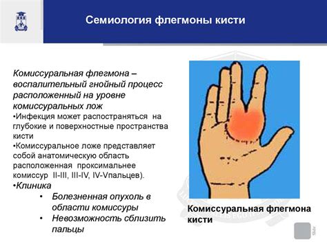 Панариций и флегмоны кисти - презентация онлайн