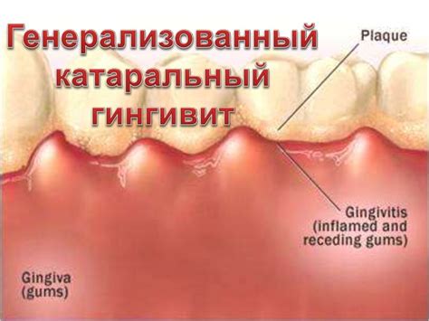 Генерализированный катаральный гингивит - презентация онлайн