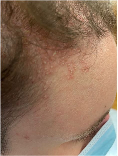jcm  full text acute localized exanthematous pustulosis alep