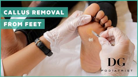 Callus removal from feet: balls of feet - YouTube