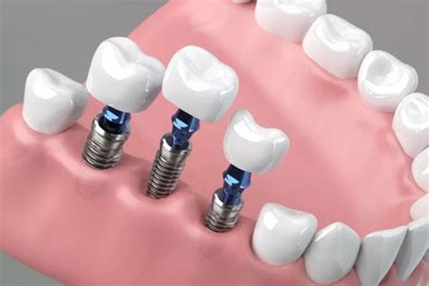 implant price dental life clinic