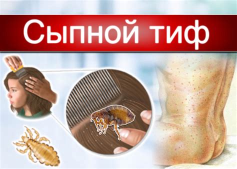 Сыпной тиф (эпидемический тиф)