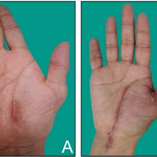 (PDF) Repair of severed recurrent thenar branch of median nerve after ...