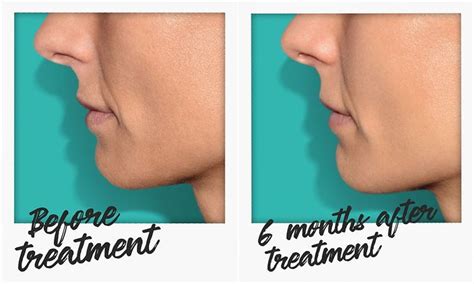 Belotero Revive Skin Booster | RJ Clinic