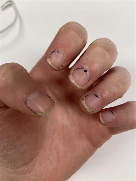 There's a second toenail growing on top of my first toenail. : r