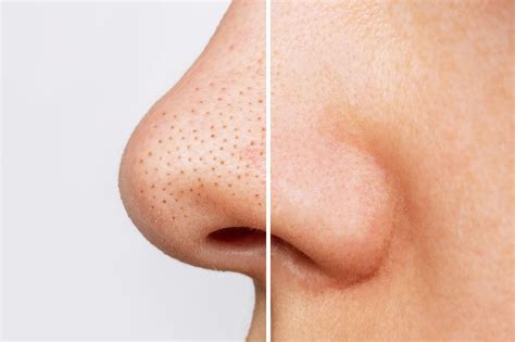 What Dermatologists REALLY Think About Unbelievable Blackhead Removal 2024! Image 18