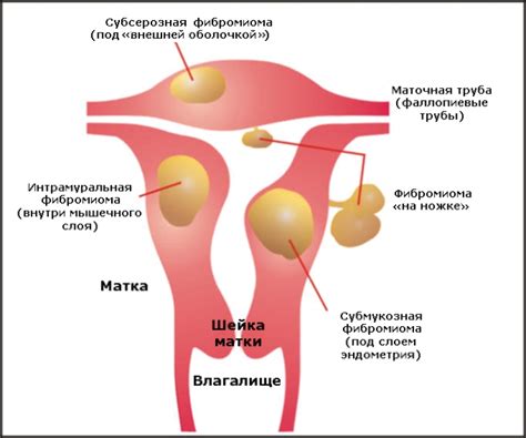 Фибромиома матки