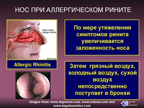 Аллергический ринит и бронхиальная астма - актуальная проблема ...