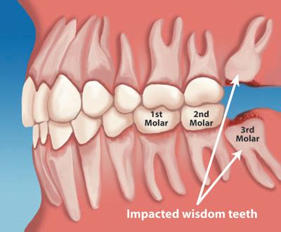 Wisdom Tooth Surgery – QUALITY DENTAL CARE
