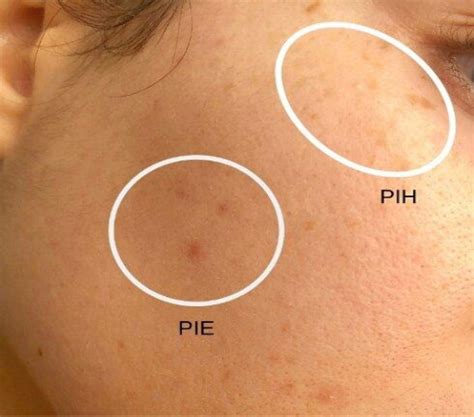 Post Inflammatory Hyperpigmentation (PIH) - DTAP Clinic