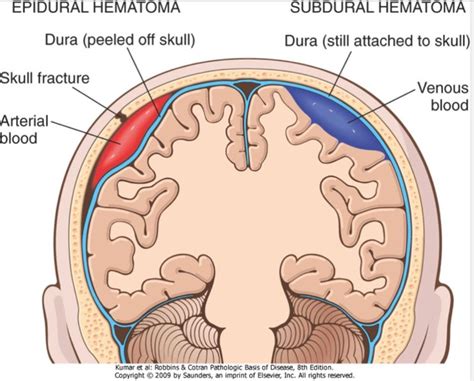 hematoma meaning types pictures symptoms treatment artofit