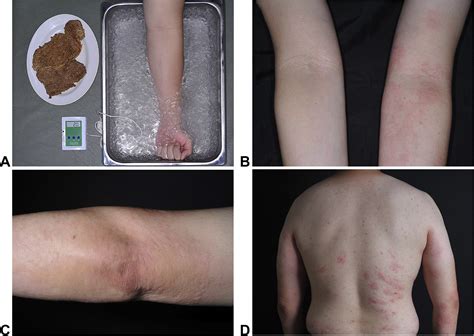 Food-dependent cold urticaria: A new variant of physical urticaria ...
