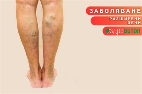 Разширени Вени