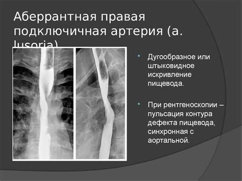 Заболевания пищевода. Смещения пищевода. Дивертикулы. Инородные тела ...