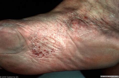 dyshidrotic eczema feet - pictures, photos