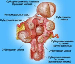 Миома матки: признаки, диагностика, профилактика — Онлайн-диагностика