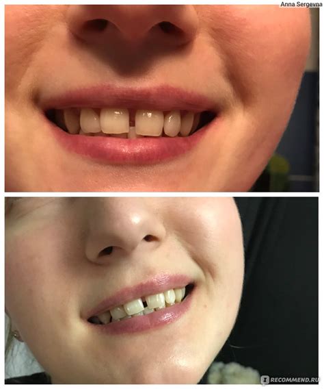 Отбеливающие полоски для зубов MyBrilliantSmile На основе ...