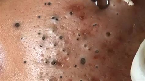 Unbelievable Blackhead Removal 2024: Debunking the Myths and Misconceptions - wqj4lwt
