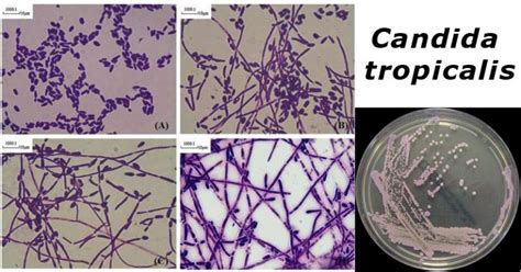 Candida tropicalis- An Overview