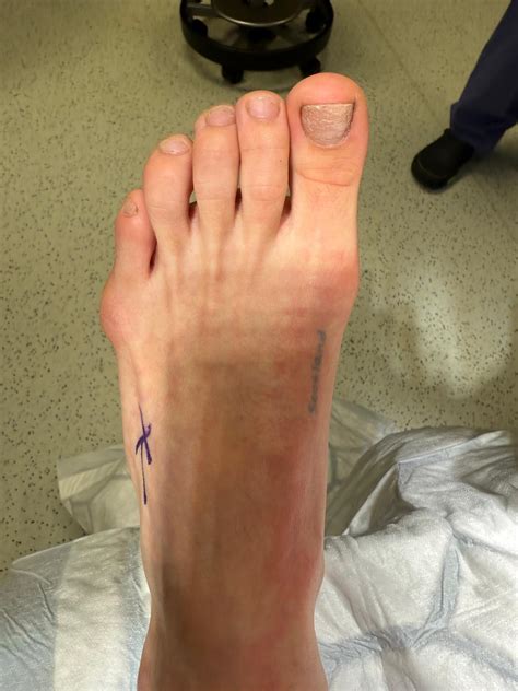 Tailor’s Bunionette Surgery: Causes, Symptoms & Keyhole Treatment