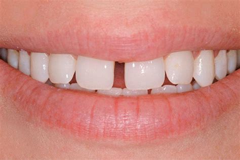 Диастема ️ Исправление щели между зубами в Ирпене | MySmile®