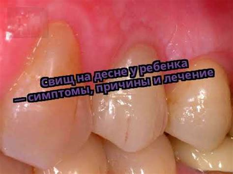 Свищ на десне у ребенка — симптомы, причины и лечение - YouTube