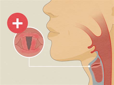How to Get Your Voice Back Fast: Treatments & Home Remedies