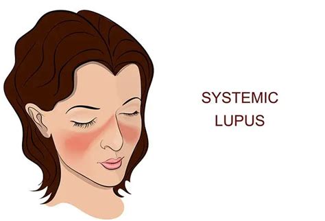 lupus    butterfly rash